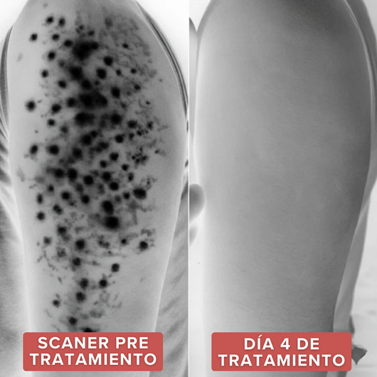 Strawberry™  | Alivia la Queratosis Pilaris desde la raíz