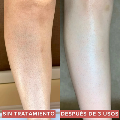 Strawberry™  | Alivia la Queratosis Pilaris desde la raíz