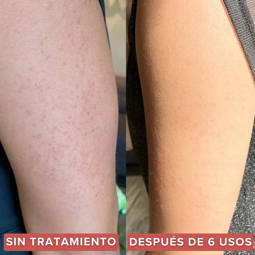 Strawberry™  | Alivia la Queratosis Pilaris desde la raíz